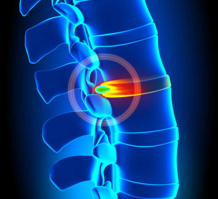 herniated disc herniated disc