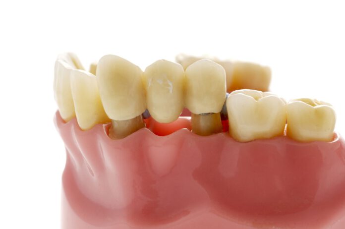 Dental Bridges Dental Bridges