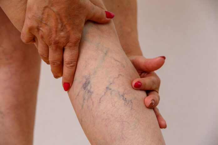 Athletes and Varicose Veins