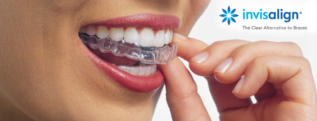 Powder Ridge Invisalign Doctor Invisalign Doctor Site Login Guide: Get Registered Now | Mind Setters
